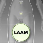 Laam Myomectomy- Laparoscopic Assisted Abdominal Myomectomy