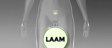 Laam Myomectomy- Laparoscopic Assisted Abdominal Myomectomy
