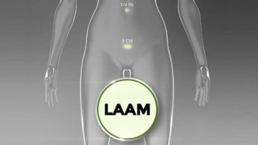 Laam Myomectomy- Laparoscopic Assisted Abdominal Myomectomy