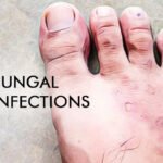 Fungal Infections Natural Remedies