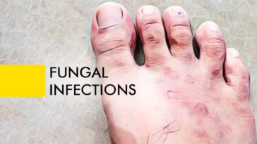 Fungal Infections Natural Remedies