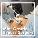 Mini Gastric Bypass Surgery: Revolutionizing Bariatric Surgery