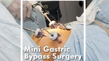 Mini Gastric Bypass Surgery: Revolutionizing Bariatric Surgery