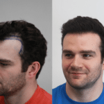 Difference Between Hairline & Hair Transplant Treatment