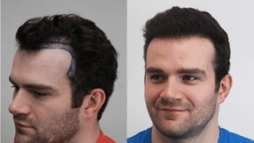 Difference Between Hairline & Hair Transplant Treatment
